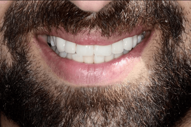 Before & After | Dental Implants in Orland Park