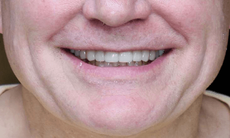 Before & After | Dental Implants in Orland Park