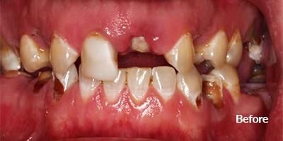 sugar not good for teeth