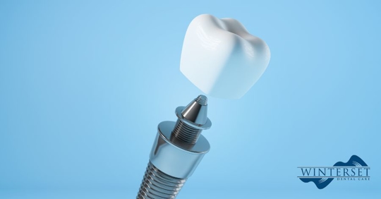 Myths About Dental Implants Debunked