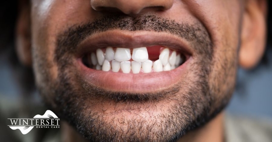 The Importance of Replacing Missing Teeth for Oral Health