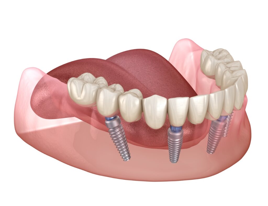 Full-mouth dental implant diagram
