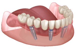 An illustration showing an arch of teeth mounted to full-mouth dental implants.