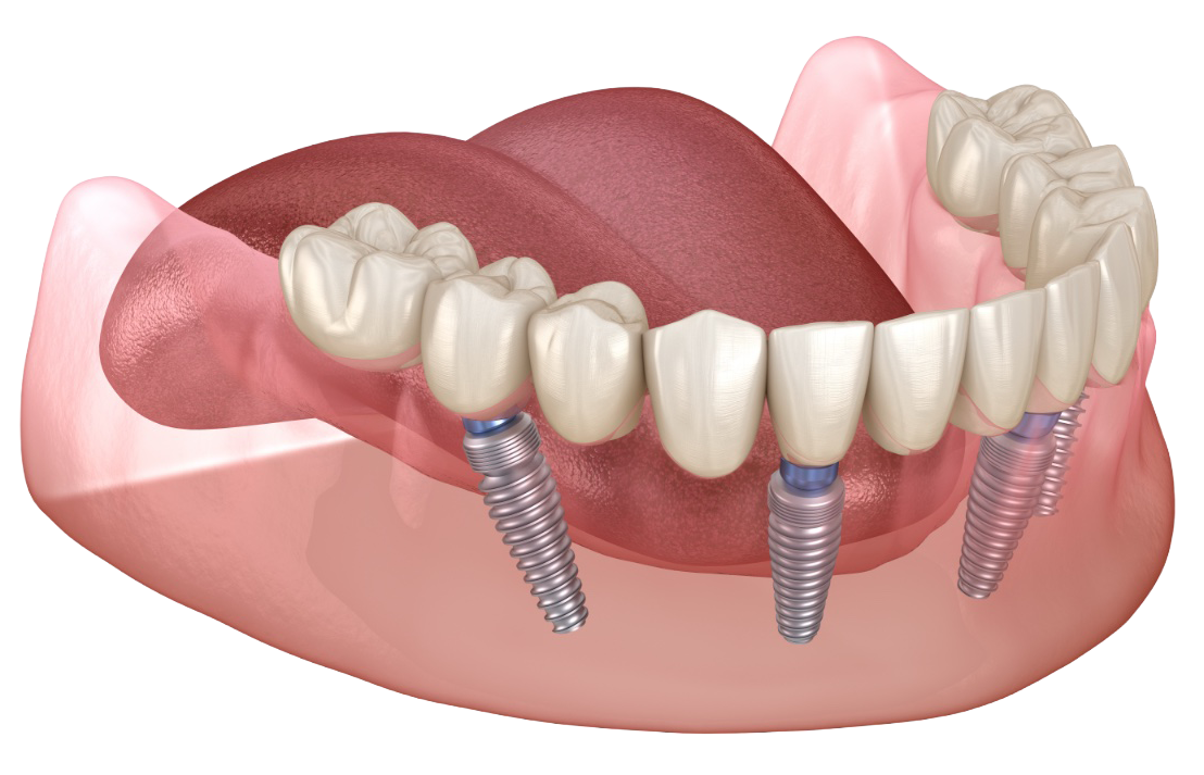 A full-mouth dental implant diagram