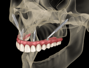 zygomatic implants