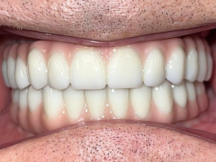 Close-up image of All-on-4 Dental Implants.