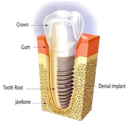 Illustration of a dental implant placed in the jawbone, with sections labeled as Crown, Gum, Tooth Root, Jawbone and Dental Implant.