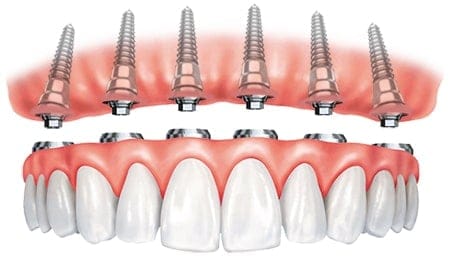 Implant-Supported Full-Arch Teeth Replacement