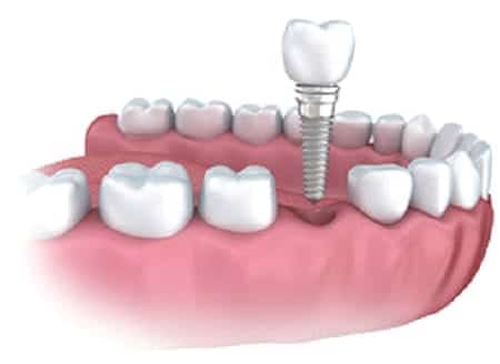 dental implants for missing teeth in chicago and orland park